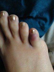 brokentoe